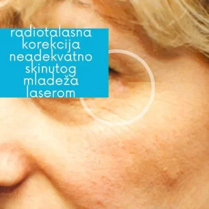 Korekcija laserskog skidanja mladeža - radiotalasno uklanjanje mladeža