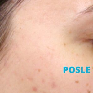 laser-za-oziljke-od-akni-iskustva-posle-poliklinika-diva