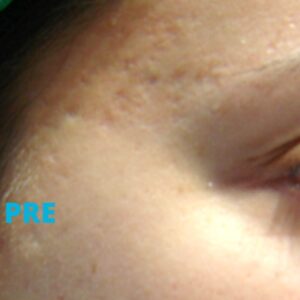 laser-za-oziljke-od-akni-iskustva-pre-poliklinika-diva