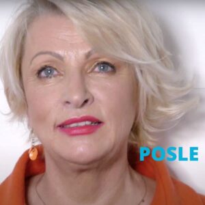 lasersko-podmladjivanje-lica-iskustva-posle-poliklinika-diva-dr-bogdanovic