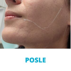 lasersko-uklanjanje-dlacica-sa-lica-iskustva-posle-poliklinika-diva