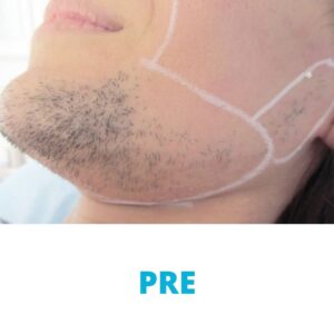 lasersko-uklanjanje-dlacica-sa-lica-iskustva-pre-poliklinika-diva