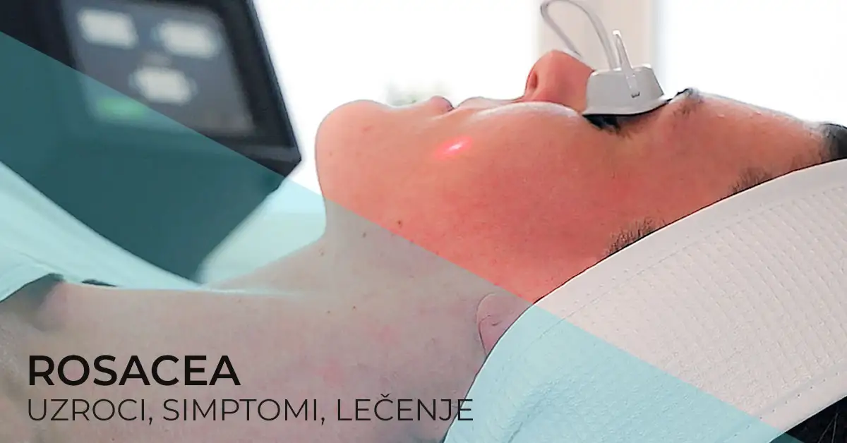 lecenje-rozacea-laserom-rosacea-crvenilo-diva-poliklinika-dr-bogdanovic
