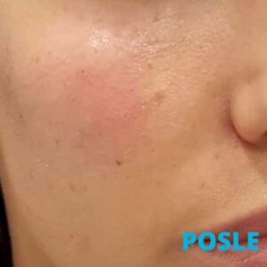 lifting-jagodica-hijaluronom-posle-poliklinika-diva