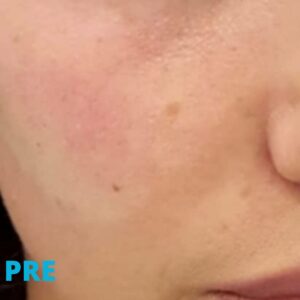 lifting-jagodica-hijaluronom-pre-poliklinika-diva