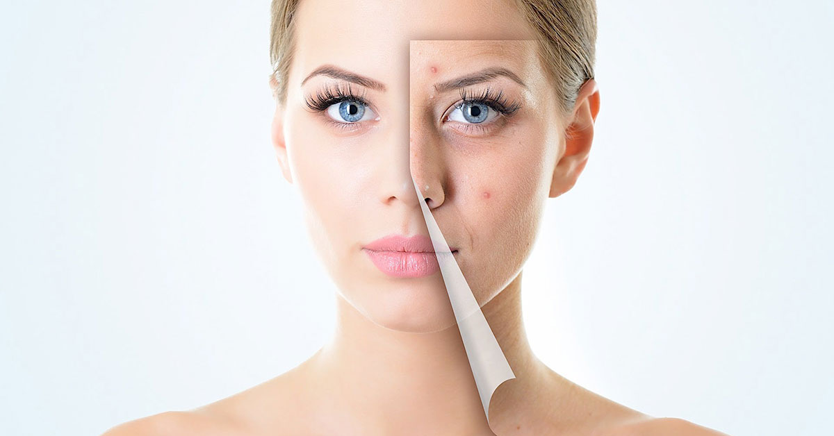 mladezi-bradavice-hijaluron-mezoterapija-diva-lasersko-lecenje-akni-blog