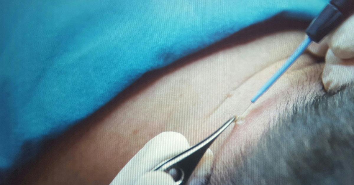 mladezi-bradavice-hijaluron-mezoterapija-poliklinika-diva-radiotalasne-intervencije