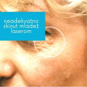 Neadekvatno skidanje mladeža laserom