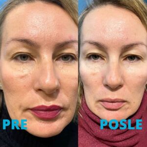 nehirurski-lifting-lica-morfeus-8-pre-i-posle-procedure-poliklinika-diva-iskustva