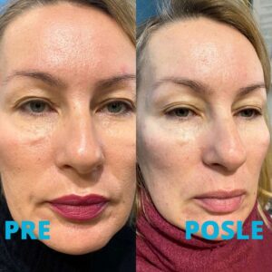 nehirurski-lifting-lica-morfeus-8-procedure-poliklinika-diva-iskustva-pre-i-posle