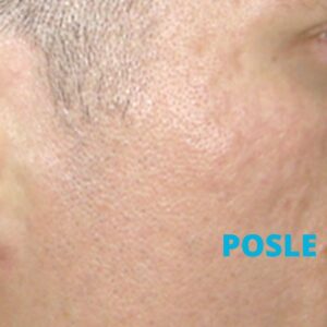 oziljci-od-akni-lasersko-uklanjanje-iskustva-posle-poliklinika-diva