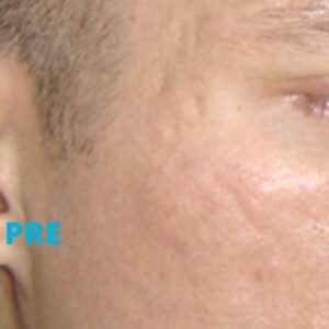 oziljci-od-akni-lasersko-uklanjanje-iskustva-pre-poliklinika-diva