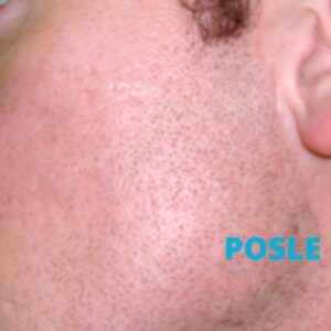 oziljci-od-akni-posle-lasera-iskustva-poliklinika-diva