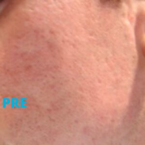 oziljci-od-bubuljica-pre-lasera-iskustva-poliklinika-diva