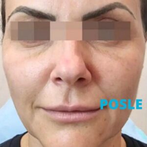 podmladjivanje-hijaluronom-iskustva-posle-poliklinika-diva