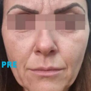 podmladjivanje-hijaluronom-iskustva-pre-poliklinika-diva