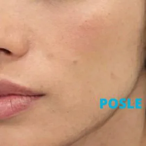 podmladjivanje-laserom-twinlight-iskustva-posle-poliklinika-diva