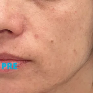 podmladjivanje-laserom-twinlight-iskustva-pre-poliklinika-diva