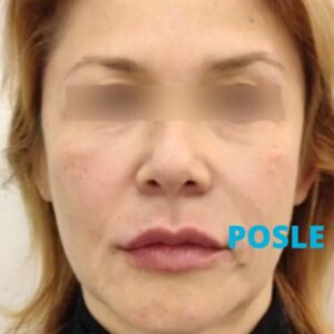 podmladjivanje-lica-hijaluronskim-filerima-posle-iskustva-poliklinika-diva