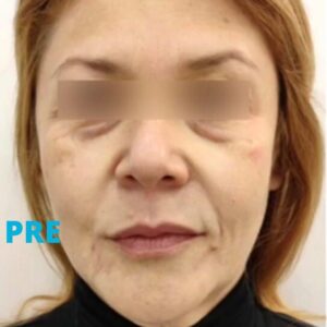 podmladjivanje-lica-hijaluronskim-filerima-pre-iskustva-poliklinika-diva