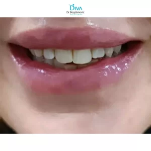 poliklinika-diva-dr-bogdanovic-povecanje-usana-hijaluronom