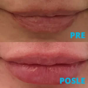 poliklinika-diva-korekcija-usana-hijaluronom-pre-i-posle