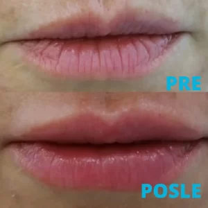 poliklinika-diva-oblikovanje-usana-hijaluronskim-filerima