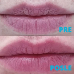 poliklinika-diva-popunjavanje-usana-hijaluronom-pre-i-posle