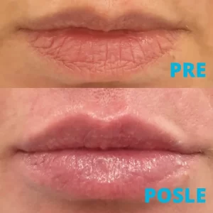 poliklinika-diva-popunjavanje-usana-hijaluronskim-filerima