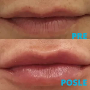 poliklinika-diva-povecanje-usana-hijaluronom-pre-i-posle