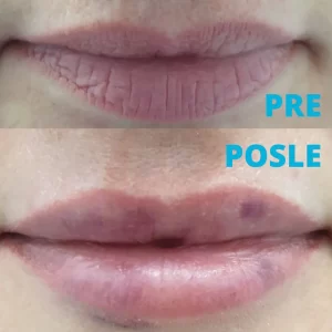 poliklinika-diva-rezultat-posle-povecanja-usana-hijaluronom