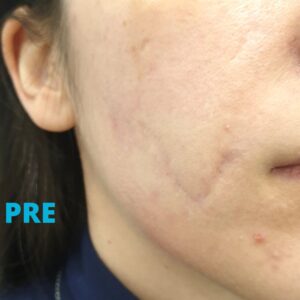 popunjavanje-oziljaka-hijaluronom-pre-poliklinika-diva