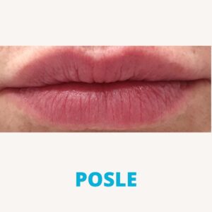 popunjavanje-usana-hijaluronom-poliklinika-diva-dr-bogdanovic-posle