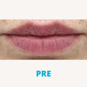 popunjavanje-usana-hijaluronom-poliklinika-diva-dr-bogdanovic-pre