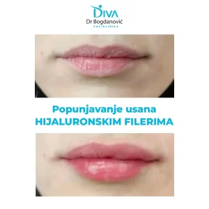 popunjavanje-usana-hijaluronskim-filerima-poliklinika-diva