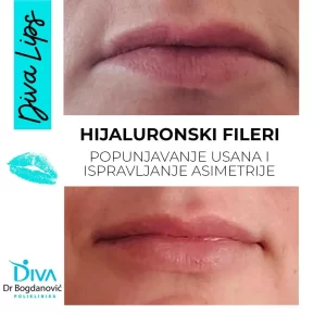 popunjavanje-usana-i-ispravljanje-asimetrije-hijaluronom-poliklinika-diva