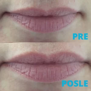 povecanje-usana-hijaluronskim-filerima-rezultat-posle-procedure-poliklinika-diva