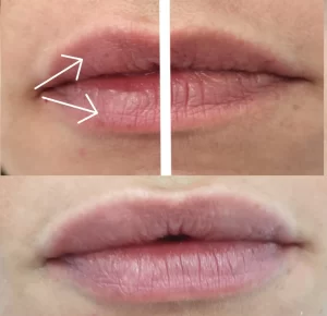 pre-i-posle-povecanja-usana-hijaluronskim-filerima-poliklinika-diva