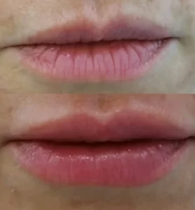 pre-posle-hijaluron-usne-poliklinika-diva