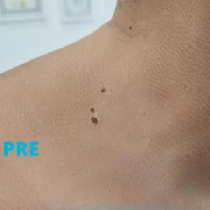 radiotalasno-skidanje-bradavica-pre-poliklinika-diva