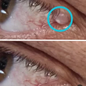 radiotalasno-uklanjanje-benignog-izrastaja-na-uglu-kapka-poliklinika-diva