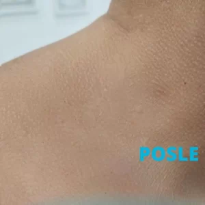 radiotalasno-uklanjanje-bradavica-posle-poliklinika-diva