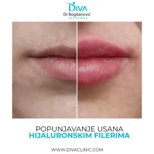 rezultat-popunjavanja-usana-hijaluronom-poliklinika-diva