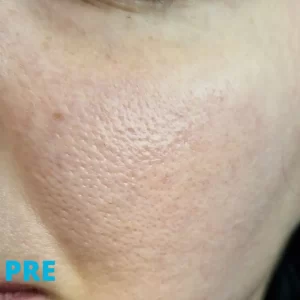 rosacea-lecenje-laserom-iskustva-pre-poliklinika-diva-dr-bogdanovic