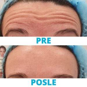 uklanjanje-bora-botoksom-celo-pre-i-posle-iskustva-poliklinika-diva