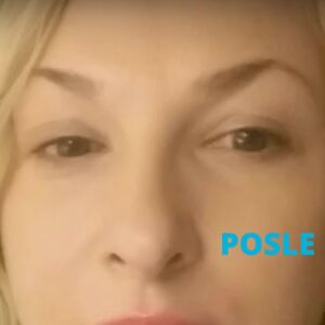 uklanjanje-bora-izmedju-obrva-botoksom-poliklinika-diva-posle