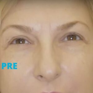 uklanjanje-bora-izmedju-obrva-botoksom-poliklinika-diva-pre