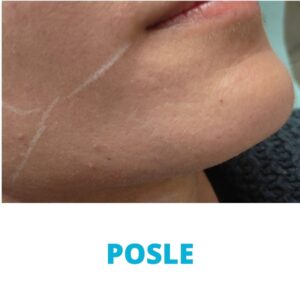 uklanjanje-dlacica-sa-lica-laserom-iskustva-posle-poliklinika-diva