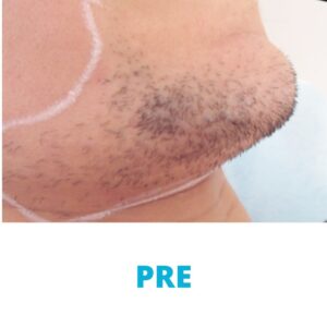 uklanjanje-dlacica-sa-lica-laserom-iskustva-pre-poliklinika-diva