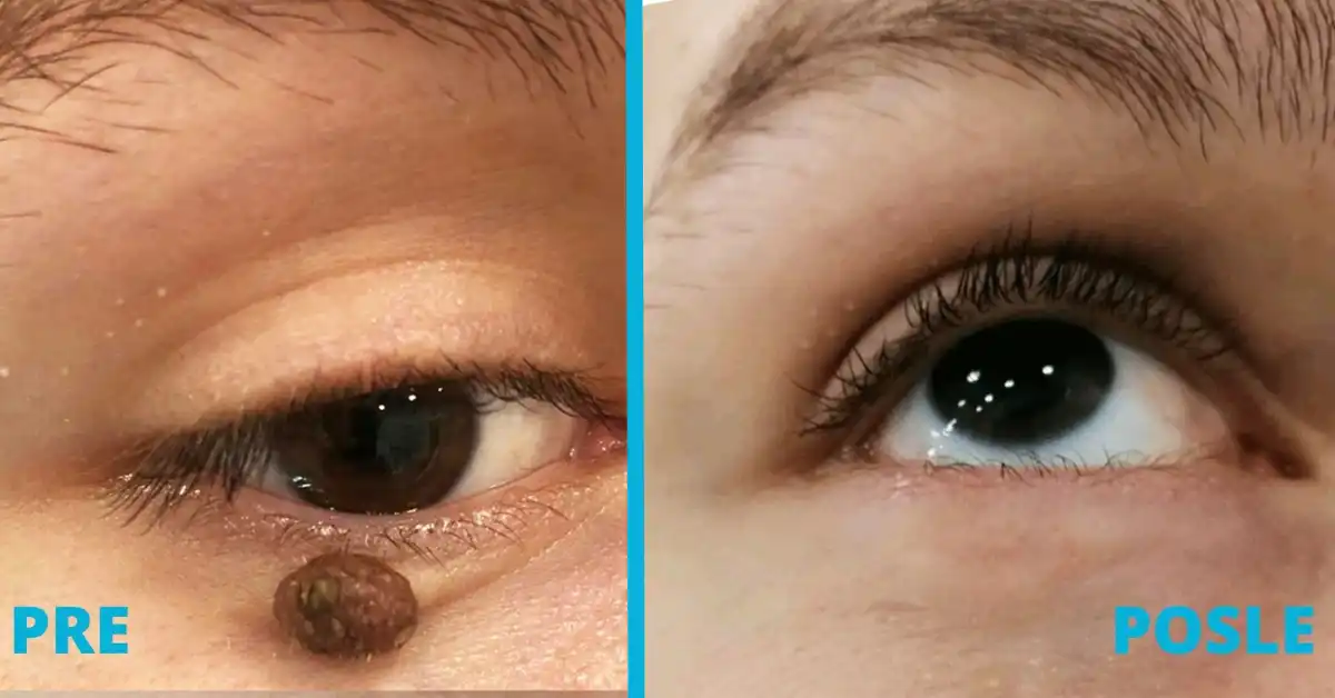 Uklanjanje mladeža radiotalasima iskustva pre i posle u poliklinici Diva dr Bogdanović